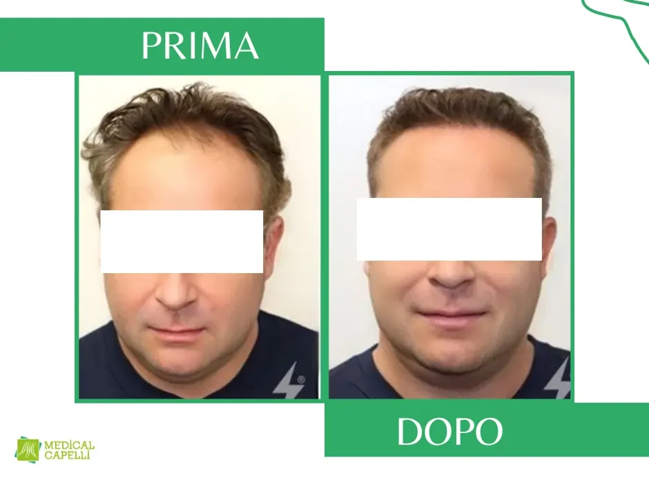 Tricopigmentazione Medica Medical Capelli Palermo