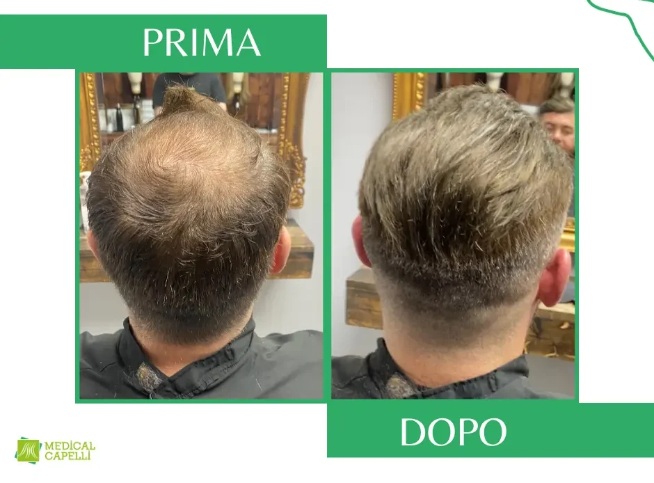 Membrana Capillare Invisibile Medical Capelli Palermo