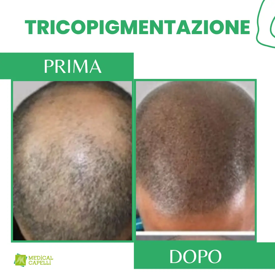 Tricopigmentazione Medica Medical Capelli Palermo