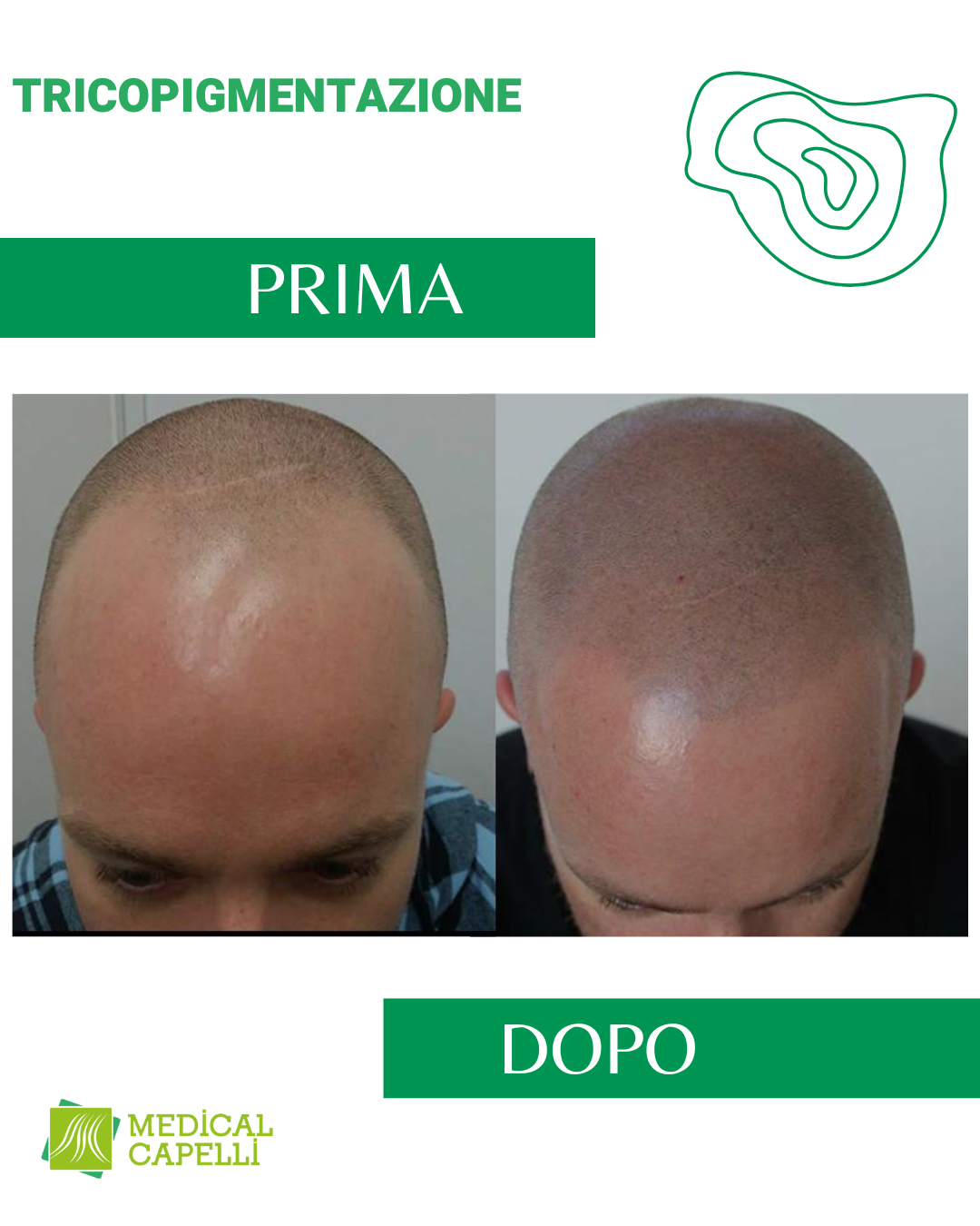 Tricopigmentazione Medica Medical Capelli Palermo
