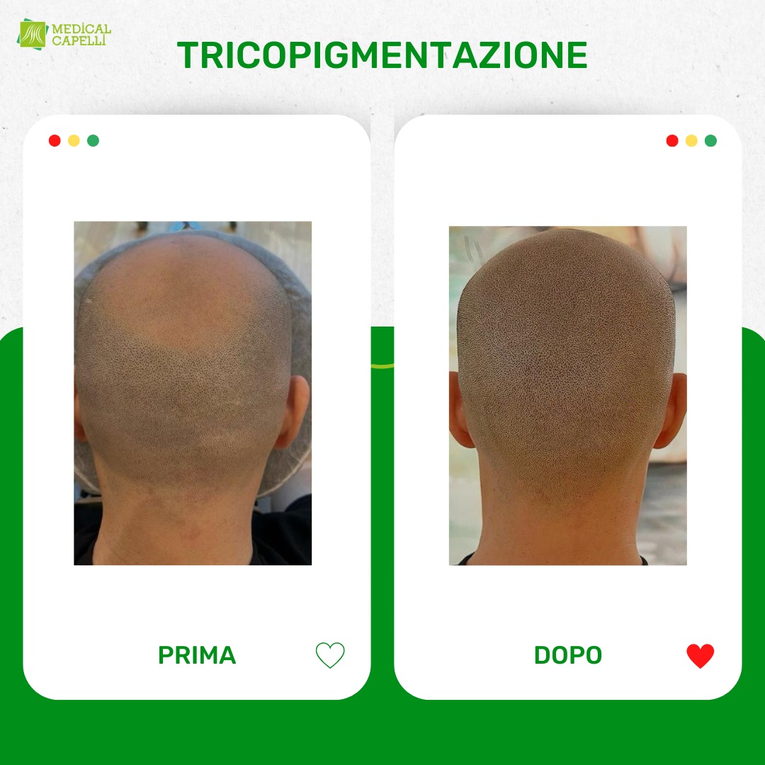 Tricopigmentazione Medica Medical Capelli Palermo