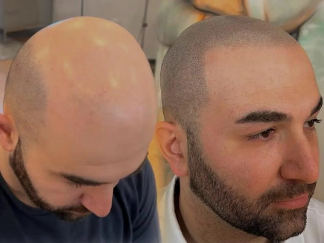 Tricopigmentazione Medica Medical Capelli Palermo
