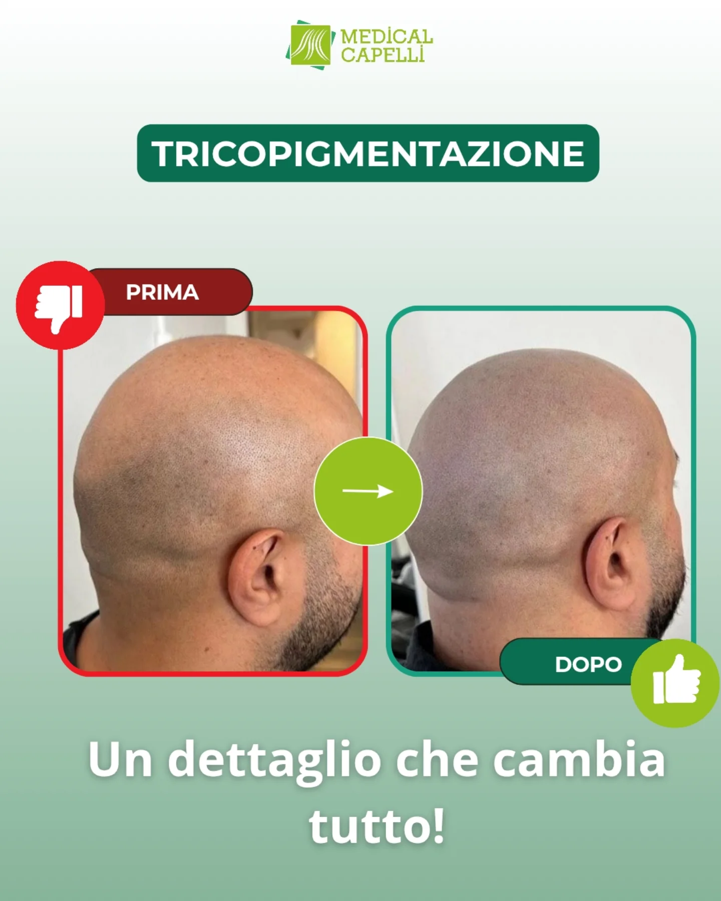 Tricopigmentazione Medica Medical Capelli Palermo