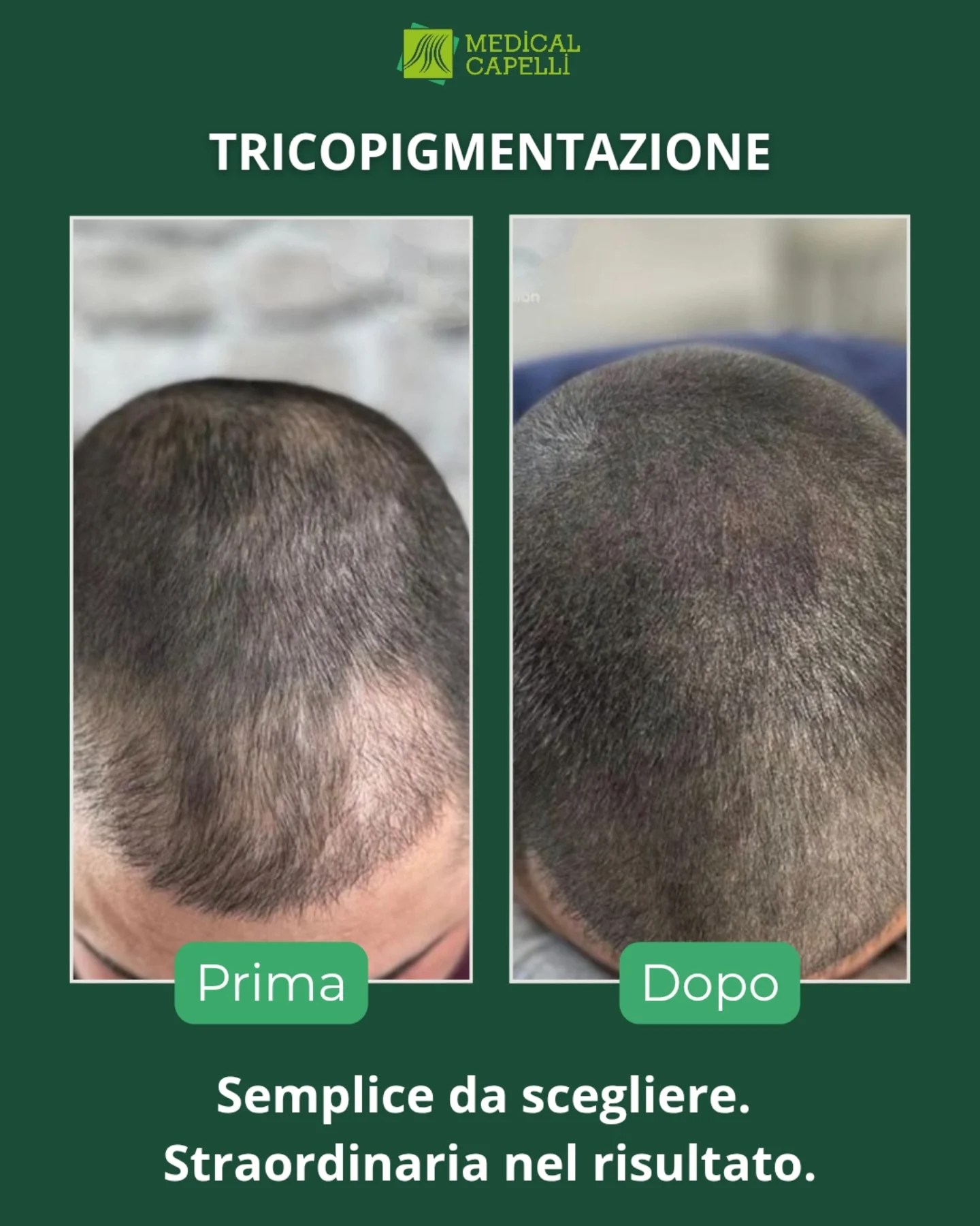 Tricopigmentazione Medica Medical Capelli Palermo